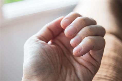 how to take care of a hangnail