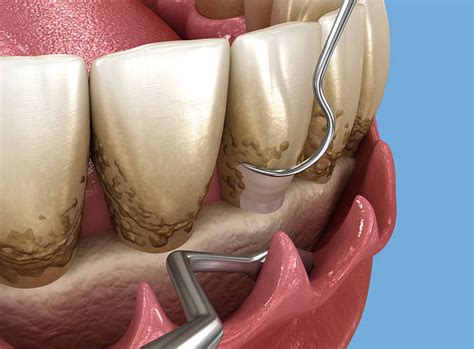 periodontal treatment stock  pictures royalty  images