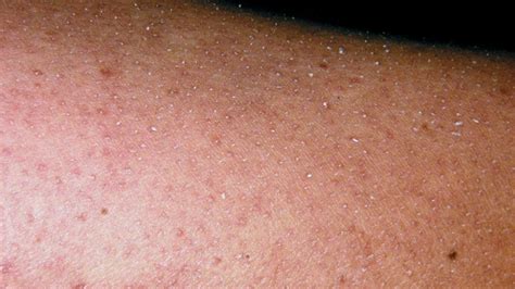 Keratosis Pilaris Diet: Why It Doesn't Work, Plus Proven Remedies