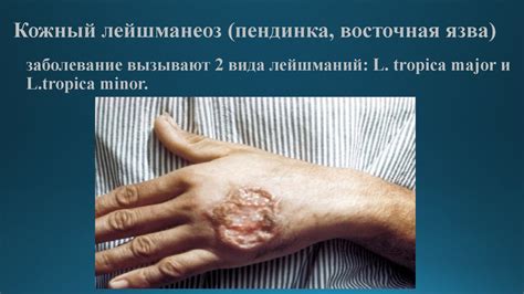 Лейшмании Leischmania - возбудители лейшманиозов - презентация онлайн