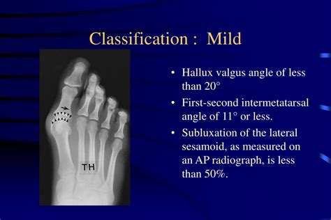 PPT - Hallux Valgus PowerPoint Presentation, free download - ID:1046068