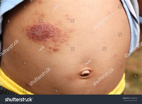 how to know eczema is infected