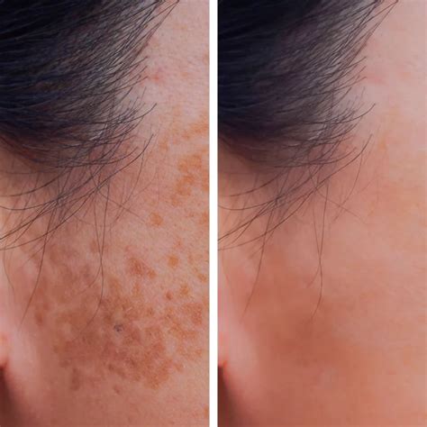 laser  pigmented lesions shubham skin clinic award winning skin