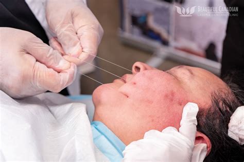 thread lifting facelifts  popular