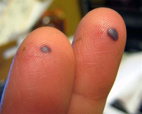 blood blisters