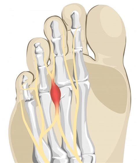 Mortons Neuroma, Symptoms, Causes and Treatment Options