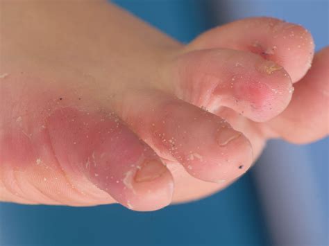 how to fix peeling skin on feet 5