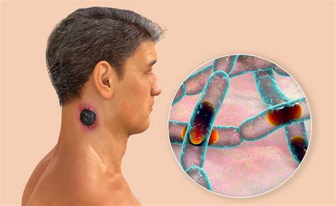 anthrax bacillus anthracis bertin environics