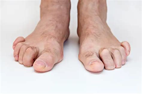 hammer toe alan  rosen dpm pc