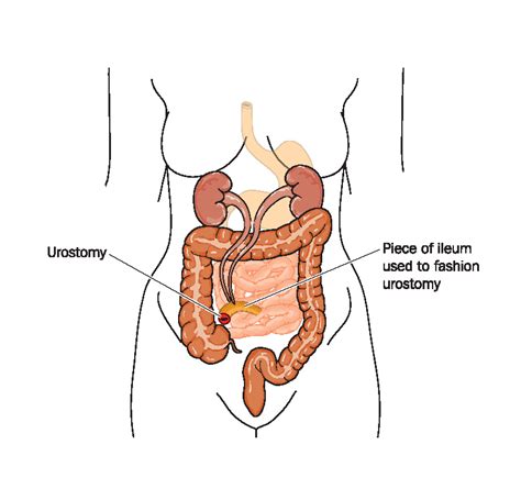 Urostomy – Ostomy New Zealand