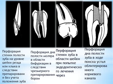 Ошибки и осложнения при эндодонтическом лечении - презентация онлайн