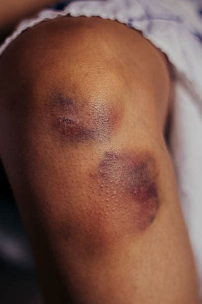 5,900+ Bruised Leg Stock Photos, Pictures & Royalty-Free Images - iStock