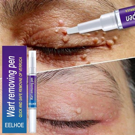Wart Removal Mole Remedy Liquid Pen Treatment Papillomas Removing Skin ...