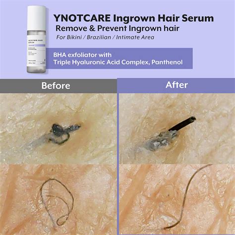 Ingrown Pubic Hair Removal Hair Removal: Different Methods To Remove