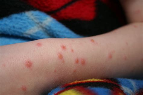 tanda awal chicken pox maxwelltaroosborn