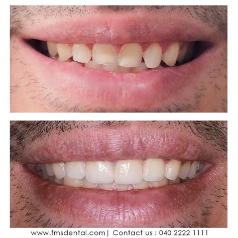 Photo Gallery - Best Dental Clinic In Hyderabad