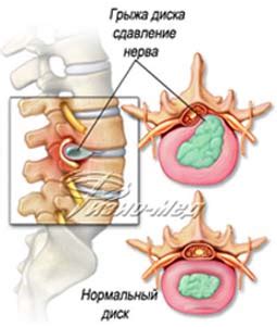 Грыжи дисков
