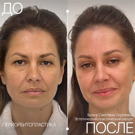 Блефаропластика в Санкт-Петербурге | Цена на нижнюю и верхнюю ...
