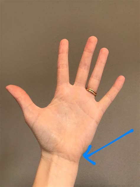 wrist pain ulnar side tfcc ulnar side wrist injuries rayner