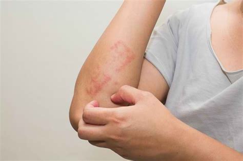 Canakinumab - Manfaat, Dosis, dan Efek Samping - Alodokter
