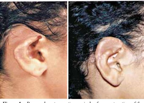 figure   ear reconstruction  traumatic injuries semantic