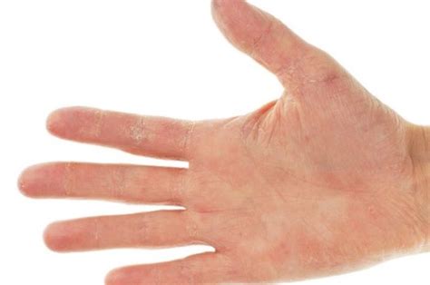 kulit bersisik waspada mungkin kamu alami hal