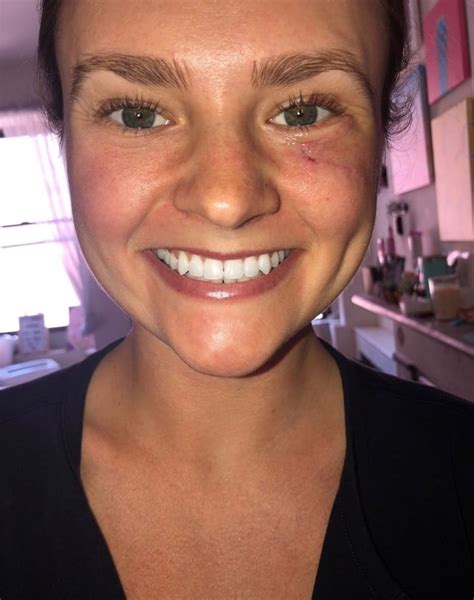 Skin cancer: Woman discovers basal cell carcinoma near eye