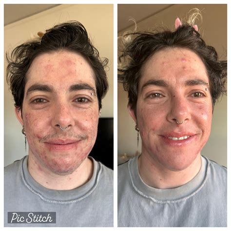 weeks  accutane    raccutane