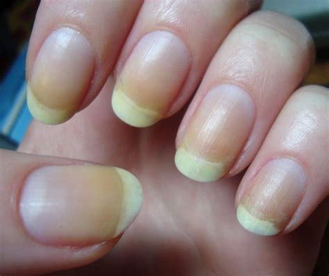 Mancha Amarelada Na Unha - manchas nas unhas amarelada | Unhas simples, Esmalte de unhas, Acertou ...