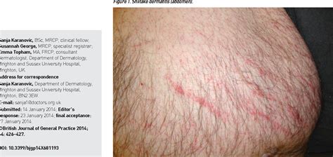 Figure 1 from Don't miss shiitake dermatitis: a case report. | Semantic ...