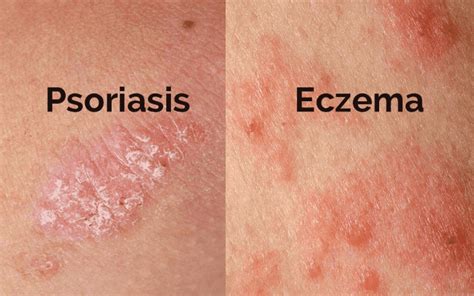 cure eczema