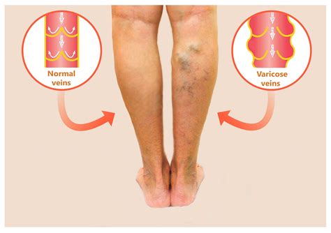 Home Treatments For Varicose Veins - The Vein Company