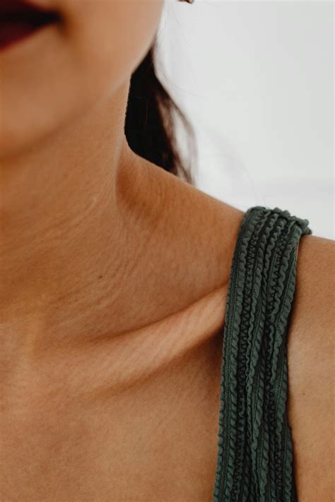 cara menghilangkan stretch mark pada paha remaja