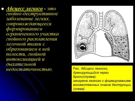 Абсцессы легких. Эмпиемы плевры - презентация онлайн