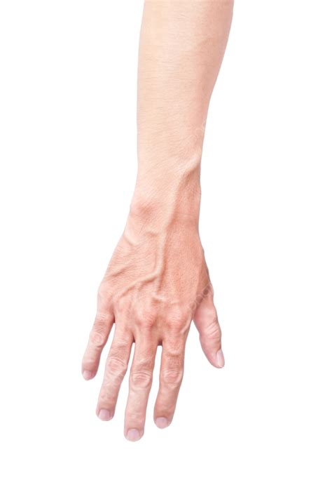 difference  normal veins  varicose veins