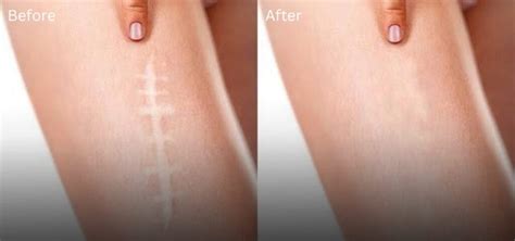 History Of Scar Camouflage Tattoos