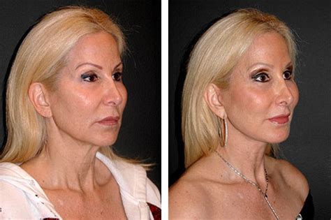 Lower Facelift | Best Lower Facelift Results in New York