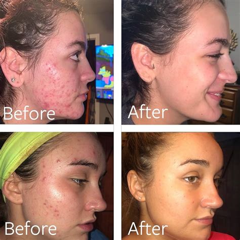 Benzoyl Peroxide For Acne: How It Works, Best Products,, 54% OFF