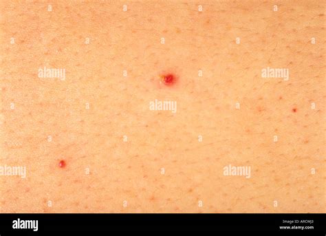 morphoea    localised scleroderma  uncommon stock photo