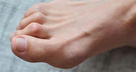 toe disorders mid ohio foot  ankle specialists