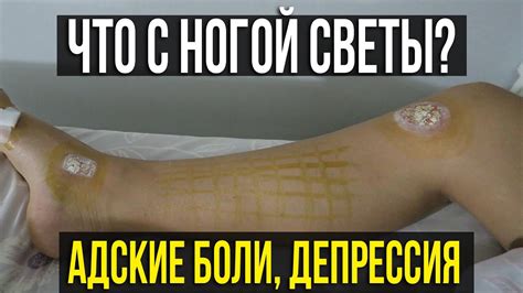 ТРЕЩИНА ИЛИ ПЕРЕЛОМ, ВОССТАНОВЛЕНИЕ ПОСЛЕ ПАДЕНИЯ С БАЙКА ☼ - YouTube