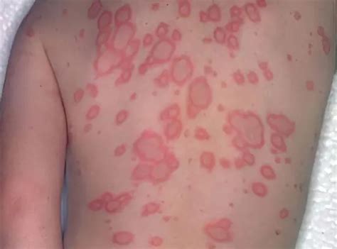 Erythema: causes, symptoms and treatment – Healthy Food Near Me