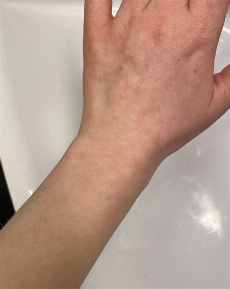 Recurring ulcers, swollen mouth, and intense joint pain, fatigue : r