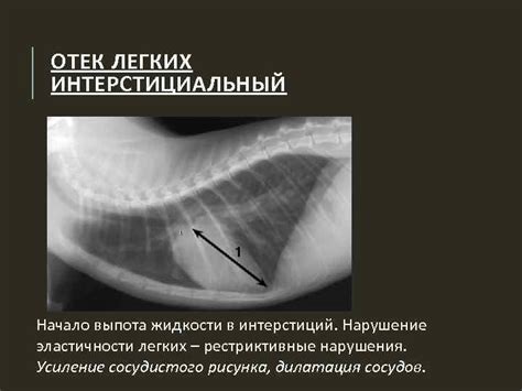 ОТЕК ЛЕГКИХ Источники 1 Дыхательная недостаточность А