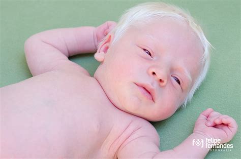 The Science and Mysticism of Albinism — #GeneOTW with OCA2 | The Su Lab