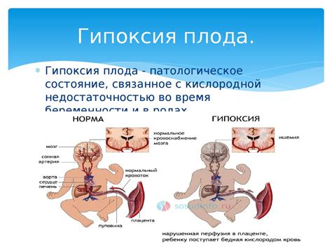 Деятельность акушерки по профилактике внутриутробной гипоксии плода и ...