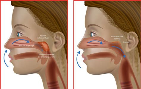 how to fix popped ears