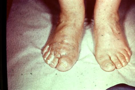 Nocardia | Nocardia | Dr. Robert J. Schoenfeld | Wayne State University