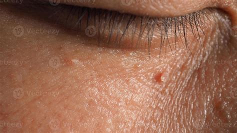 Warts All Over Face