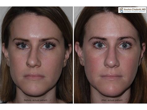 fix deviated septum surgery